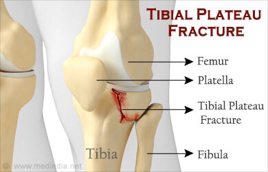 Watt The Heck Is A Tibial Plateau Fracture Anyway Boston